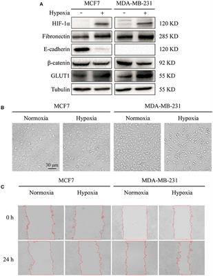 Bisecting N-Acetylglucosamine Structures Inhibit Hypoxia-Induced Epithelial-Mesenchymal Transition in Breast Cancer Cells